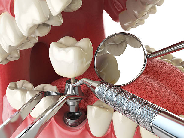 Best Knocked-Out Tooth (Avulsed Tooth) Treatment in Fox Lake, IL